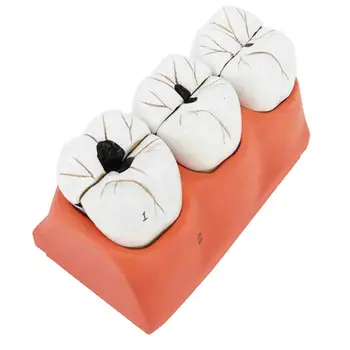 PVC Emberi fogászati fogak modellje Betegoktatási modell fogszuvasodás kezelési modell a Fogorvosi Tanszék számára kijelző